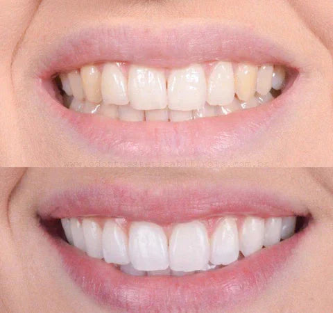 Smiley Zahnaufhellungsstift – Strahlendes Lächeln für unterwegs