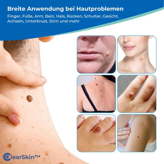 ClearSkin™ Warzenentferner Stift