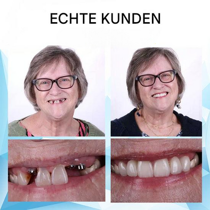 50% Rabatt | DentaFlex™ | Unterstützt das natürliche Aussehen & Gefühl Ihres Lächelns