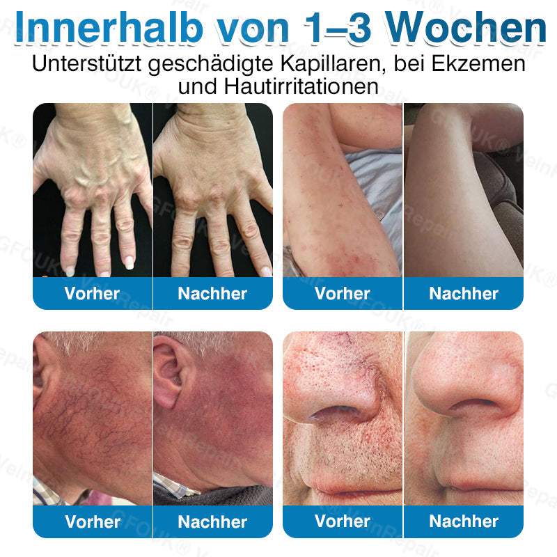 🇩🇪🥇🏆GFOUK® VeinRepair Mikronadel-Pflasterrolle⚡Sofortige Linderung, langfristige Ergebnisse