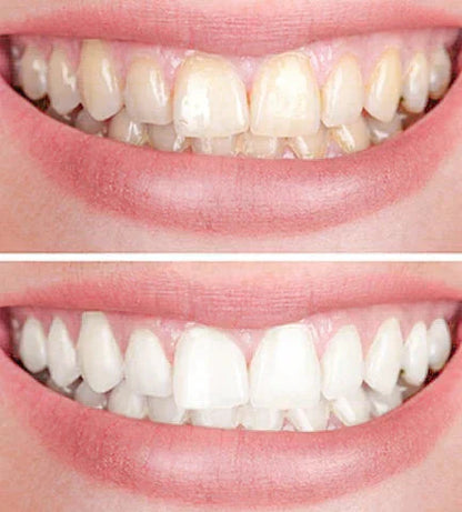 Smiley Zahnaufhellungsstift – Strahlendes Lächeln für unterwegs