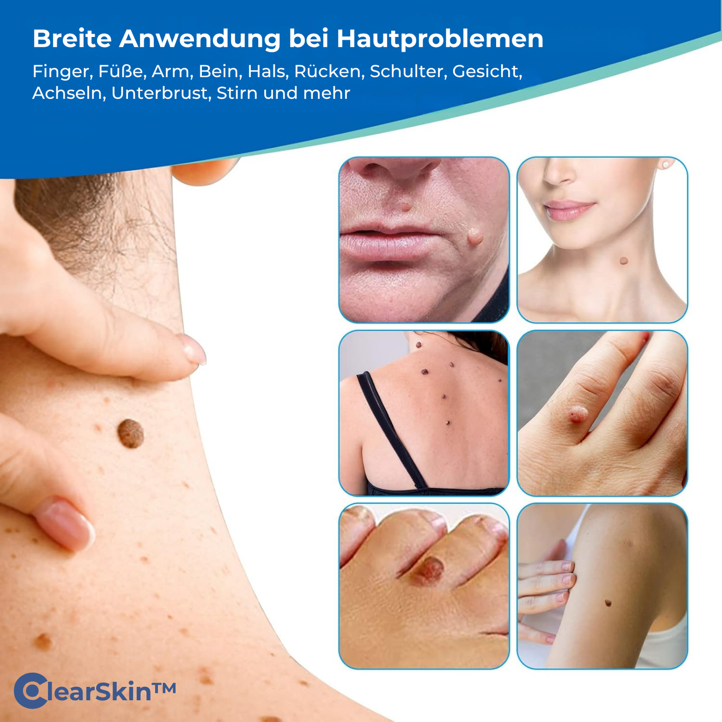 ClearSkin™ Warzenentferner Stift