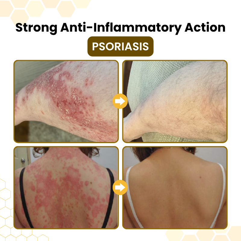 Alcuras® PsoriaSoothe – Hautregenerierende Creme mit Bienengift