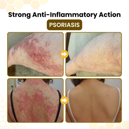 Alcuras® PsoriaSoothe – Hautregenerierende Creme mit Bienengift