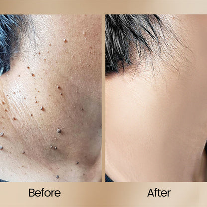 ClearSkin™ Hautpflege Spray – Jetzt 50% Rabatt sichern!