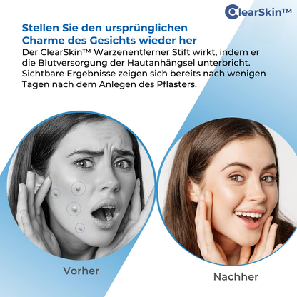 ClearSkin™ Warzenentferner Stift