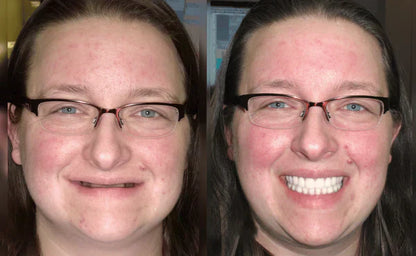 Kosmetik-Zahnersatz mit Komfort-Passform – herausnehmbares Smile-Set