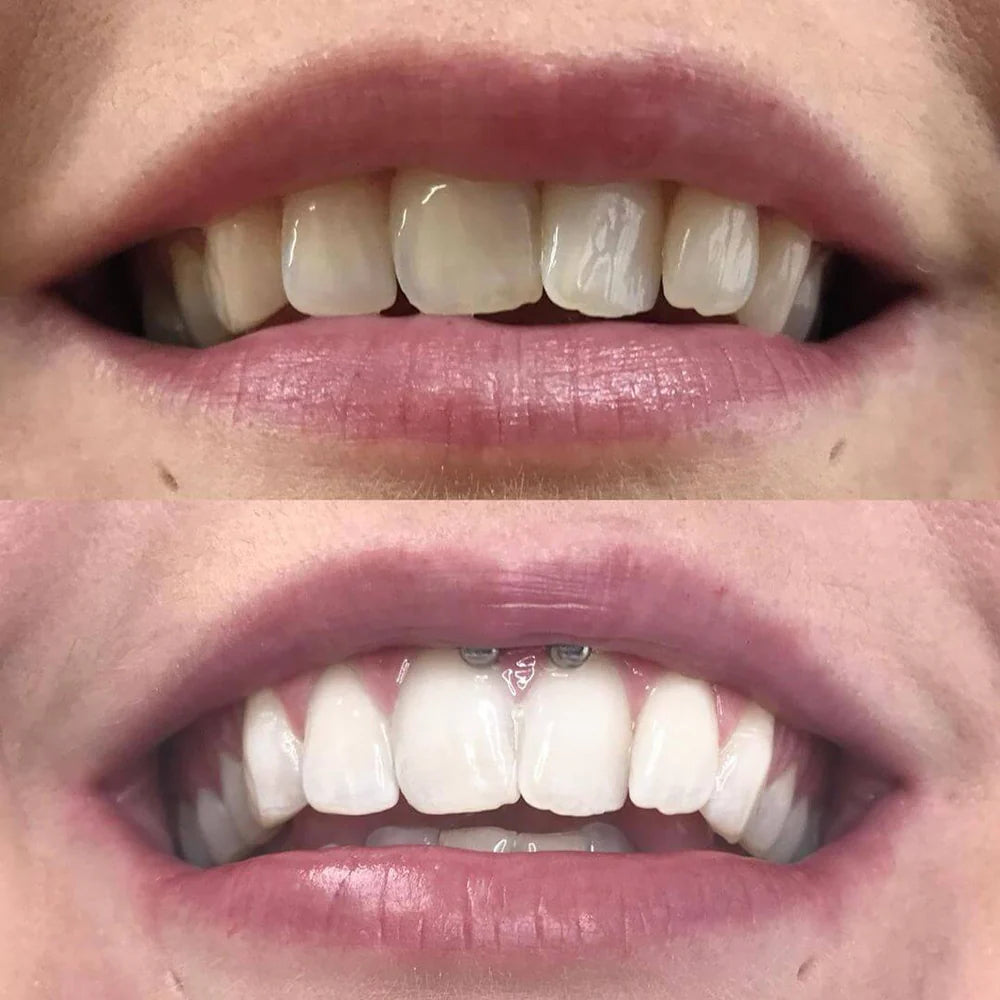 DrSmile™ – Strahlen Sie mit einem Lächeln, das jeden Raum beherrscht [1 + 1 Gratis]
