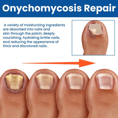 Nagelpflege-Reparatur-Patches für beschädigte und verfärbte Nägel