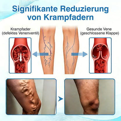 🇩🇪🏃‍🌿GFOUK® VascuCare Vein Healing Spray(Entwickelt für Krampfadern, Besenreiser, tiefe Venenthrombose (TVT), chronische venöse Insuffizienz, venöse Geschwüre, Thrombophlebitis und andere venöse Beschwerden)