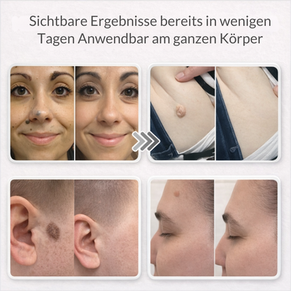 Lovera™ | Pflaster zur Entfernung von Hautanhängseln