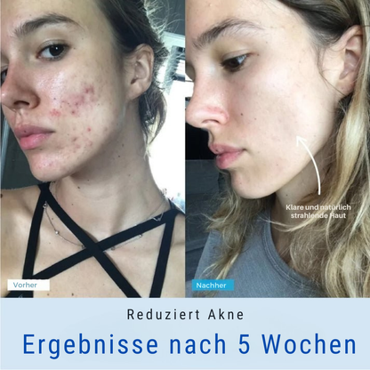 Vellista SkinLift™ | Mikrostrom & LED-Therapie für Gesicht & Hals | bekämpft Hautunreinheiten und lässt die Haut strahlen