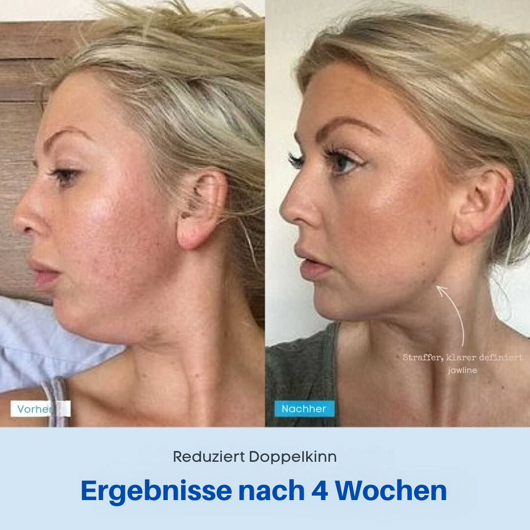 Vellista SkinLift™ | Mikrostrom & LED-Therapie für Gesicht & Hals | bekämpft Hautunreinheiten und lässt die Haut strahlen
