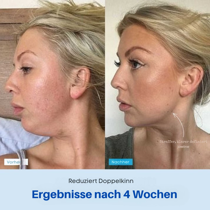 Vellista SkinLift™ | Mikrostrom & LED-Therapie für Gesicht & Hals | bekämpft Hautunreinheiten und lässt die Haut strahlen
