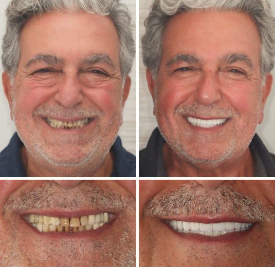 Kosmetik-Zahnersatz mit Komfort-Passform – herausnehmbares Smile-Set