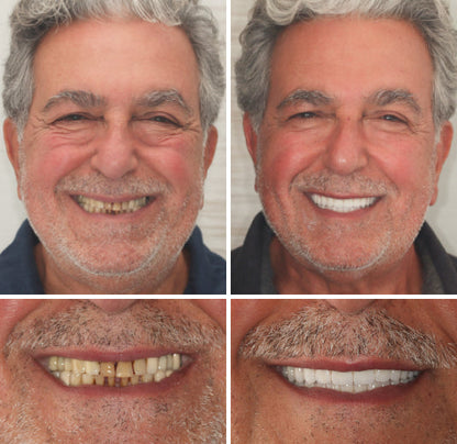 Kosmetik-Zahnersatz mit Komfort-Passform – herausnehmbares Smile-Set