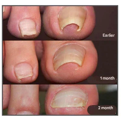 HealthyNail – Nagelpflegepflaster für ein natürliches Nagelbild