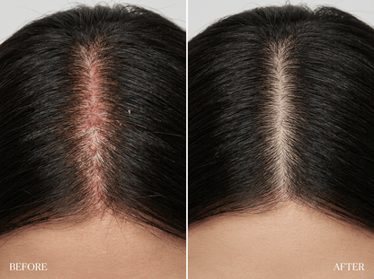 Solevia | Kopfhautmassagegerät · LED · Vibration · Öl-Infusion · Dichteres, Stärkeres Haar