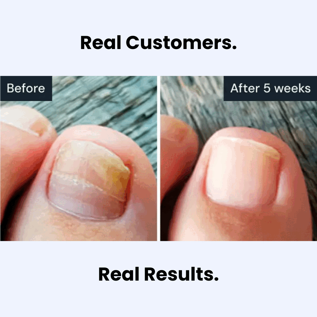 NailClear Pro+™ Nagel-Erneuerungsstift für klarer aussehende Nägel | 1 + 1 Gratis