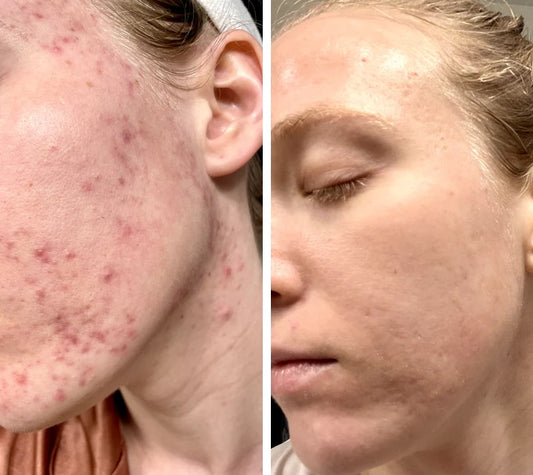 HautGlow™ | Rotlichtmaske | LED Gesichtsmaske | Haut Lichttherapie