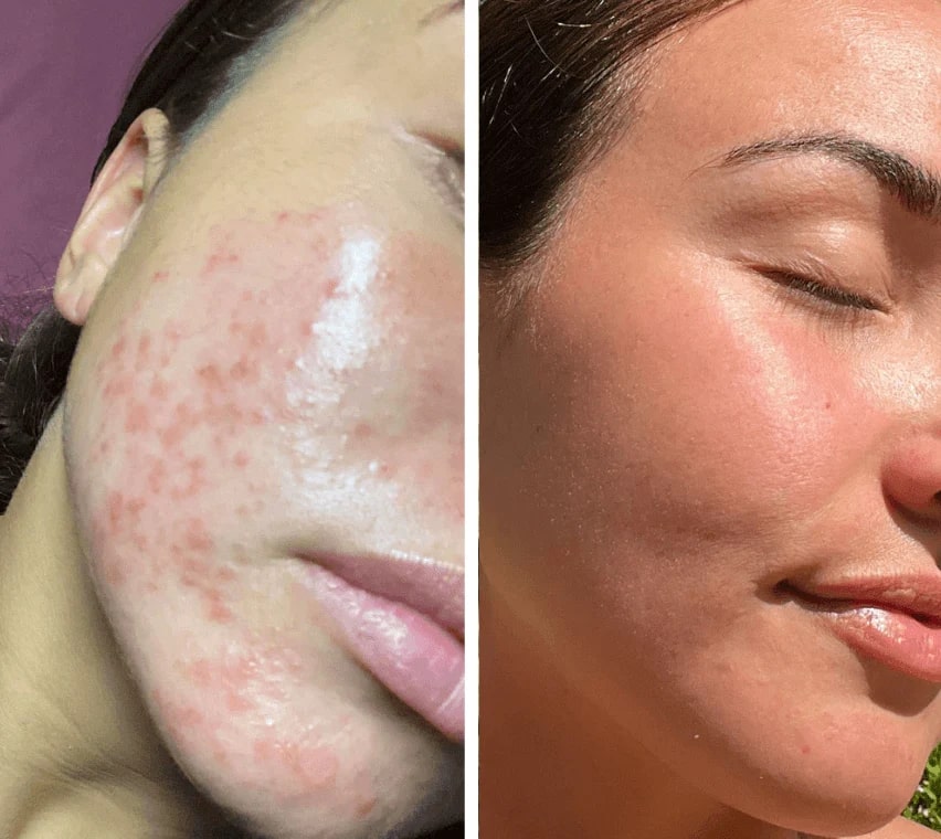 HautGlow™ | Rotlichtmaske | LED Gesichtsmaske | Haut Lichttherapie