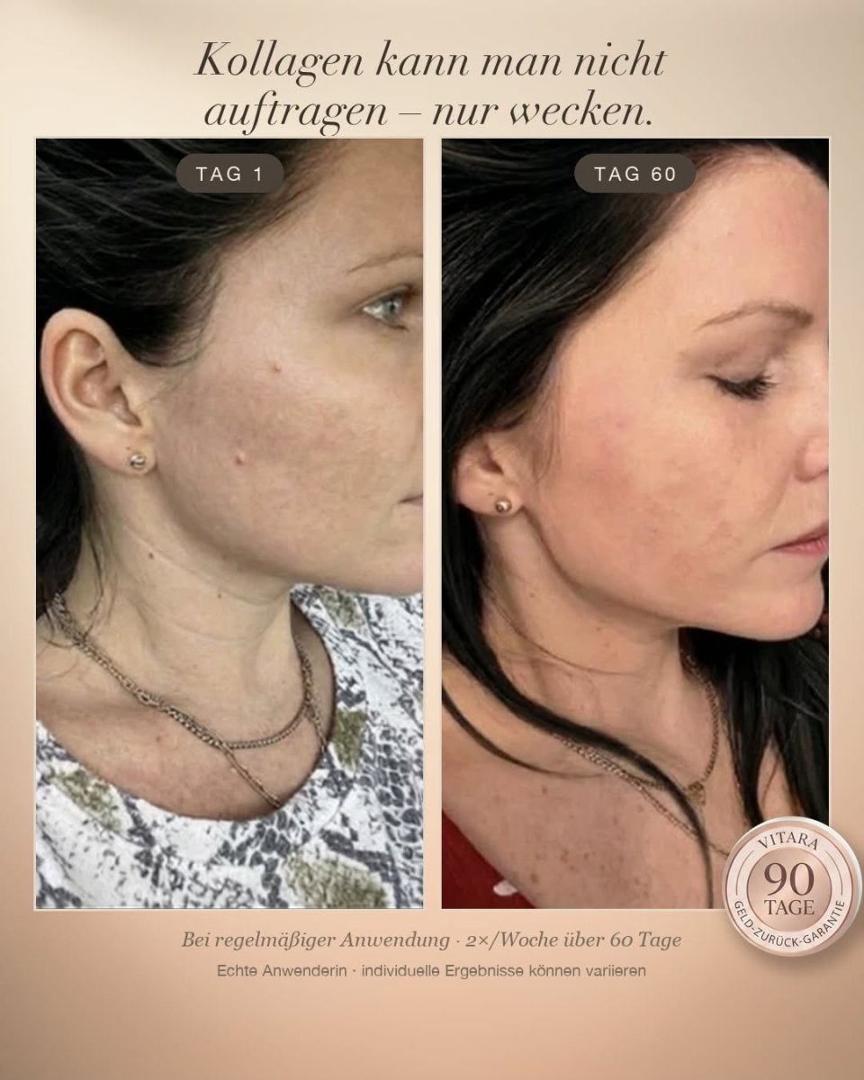 Anti-Falten-Starterset - VITARA Micro-Needling Infusion für zu Hause