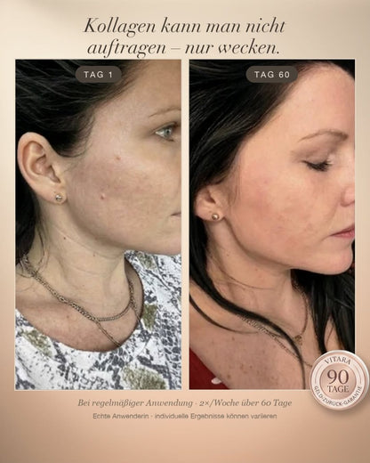 Anti-Falten-Starterset - VITARA Micro-Needling Infusion für zu Hause